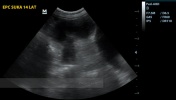 Zespół endometritis -pyometra complex